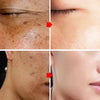 Effective Whitening Freckles Face Cream Remove Melasma Dark Spots Fade Pigmentation Acne Scars Moisturizing Brighten Beauty Care