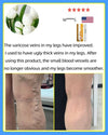 Lampshade Therapy Varicose Veins Effective Relief Of Dilated Vasculitis In The Legs Phlebitis Improved Blood Circulation Health